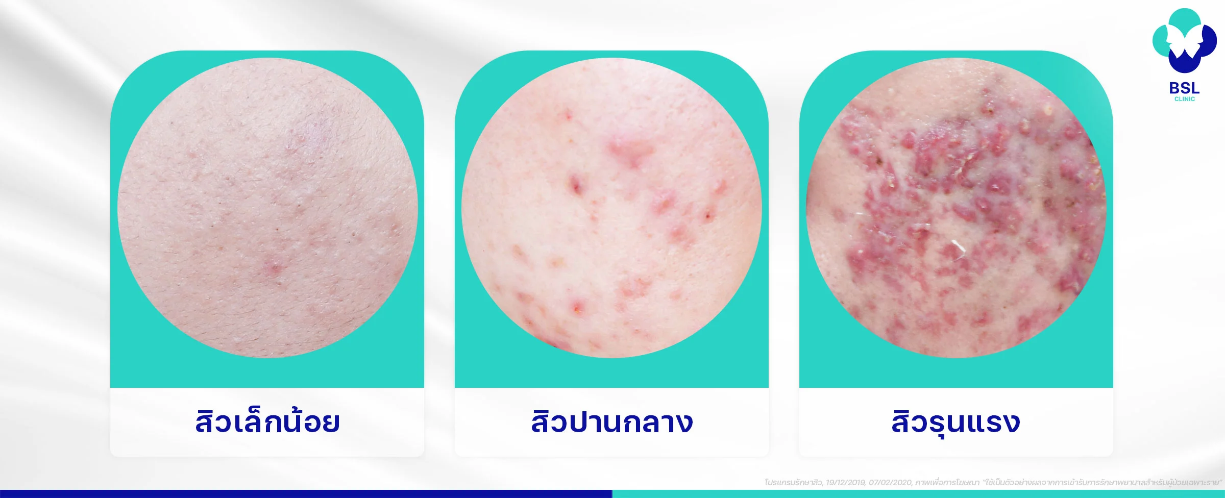 เช็คระดับความรุนแรงของสิว