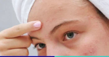 รอยแผลเป็นสิว-คีลอยด์-เกิดขึ้นได้อย่างไร