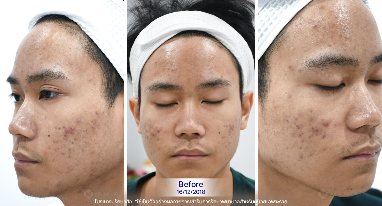 ดูแลผิวหน้าไม่สะอาด-อาจทำให้สิวเห่อได้-ผู้ชายเป็นสิว ภาพก่อนรักษาสิวของผู้ใช้บริการ มีสิวอุดตัน รอยสิว และผิวหน้าไม่เรียบเนียน