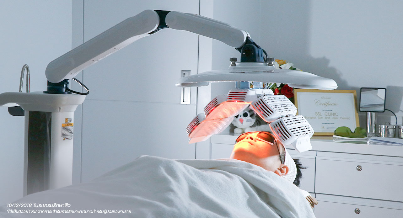 ขั้นตอนการรักษาสิวและลดรอยสิวด้วยการฉายแสงที่ BSL Clinic