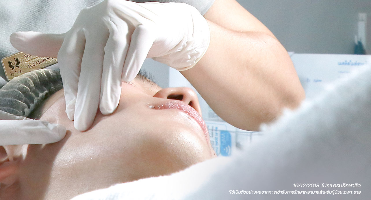 เคลียร์สิวอุดตัน ขั้นตอนการรักษาสิวและลดรอยสิวด้วยเทคโนโลยีเลเซอร์ที่ BSL Clinic