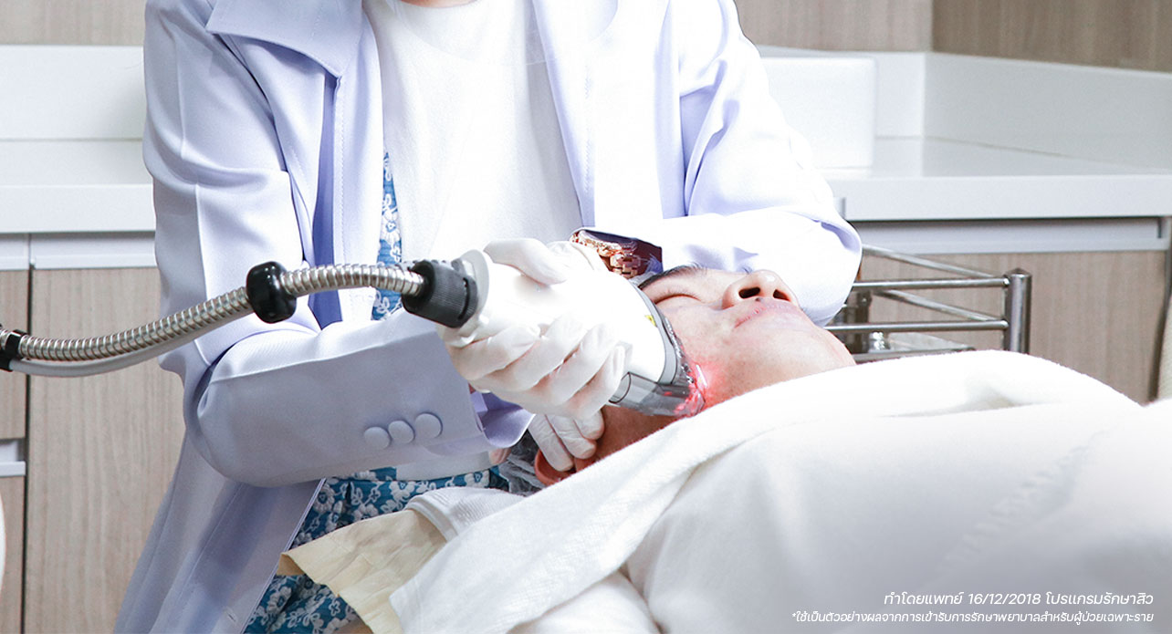 เลเซอร์รักษาสิว ขั้นตอนการรักษาสิวและลดรอยสิวด้วยเทคโนโลยีเลเซอร์ที่ BSL Clinic