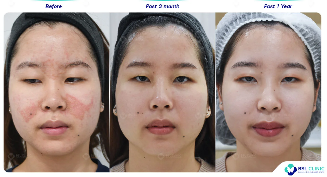ผลการรักษาสิว-ผิวแพ้ง่าย-เซ็บเดิร์ม