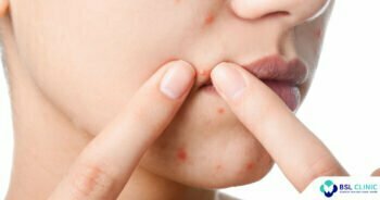 6-ขั้นตอน-รักษาสิวอักเสบ