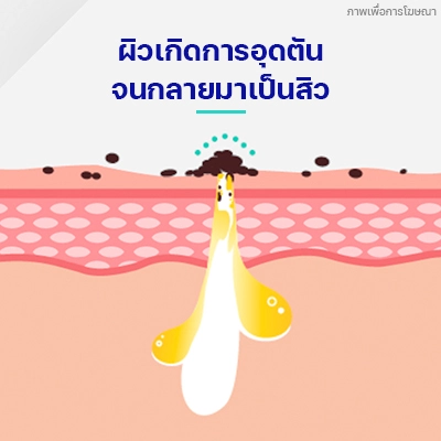 ผิวเกิดการอุดตัน