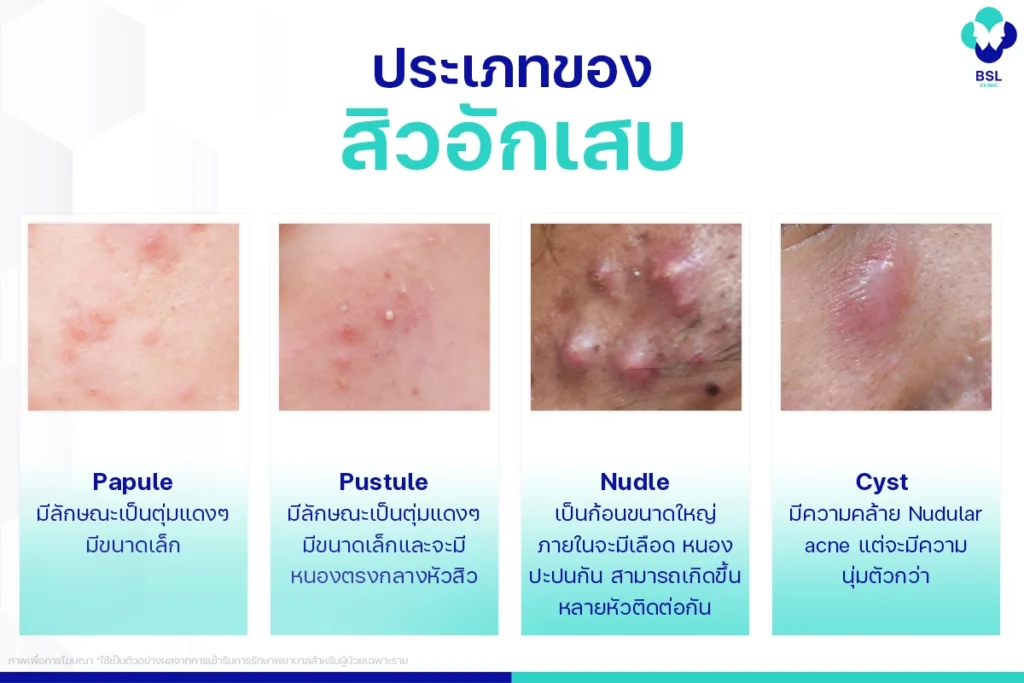 รักษาสิวอักเสบ