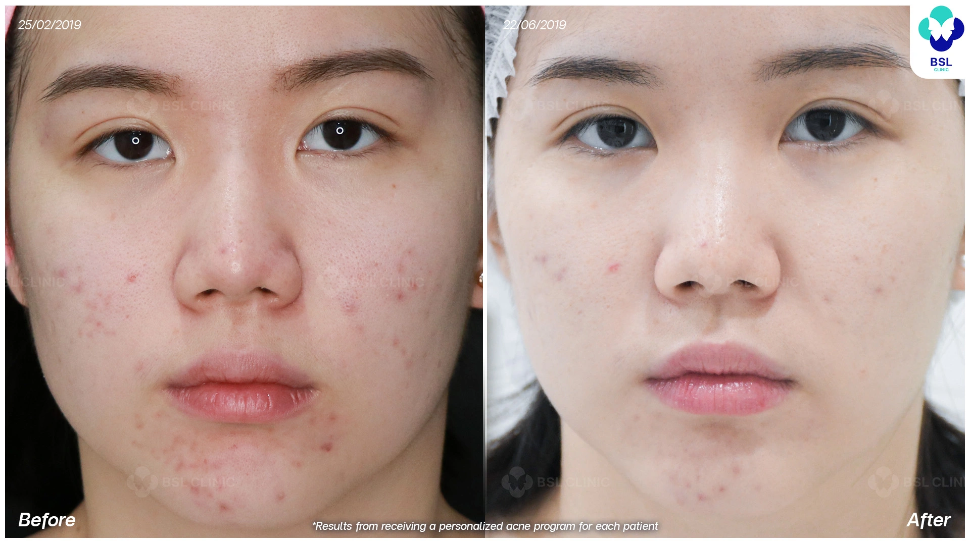 รีวิวตัวอย่างผู้รักษาสิวที่ BSL