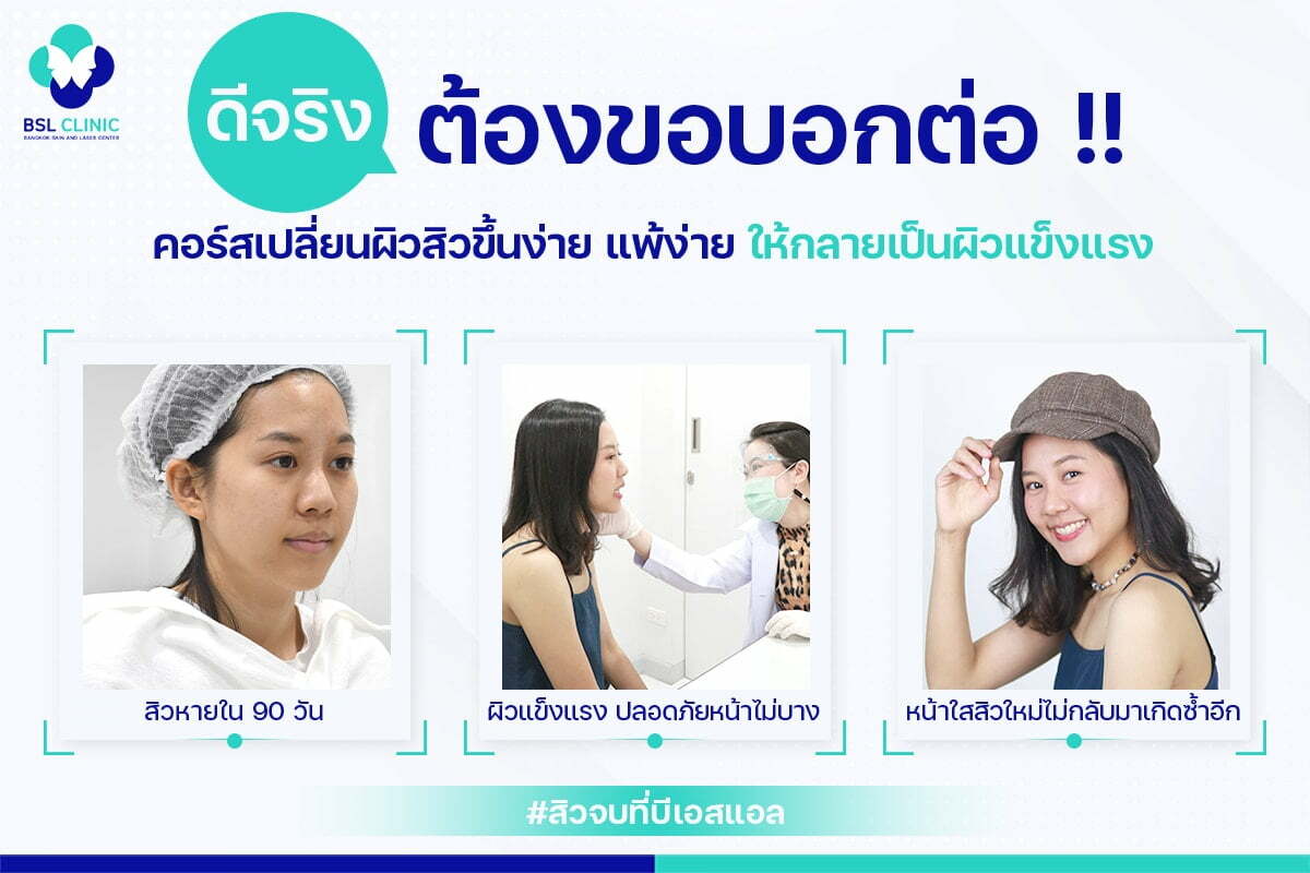 รักษาสิว