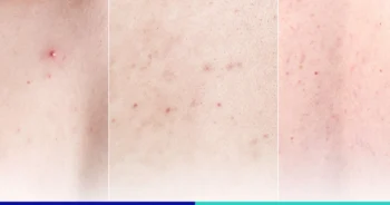 รักษาสิวที่หลังที่ BSL Clinic