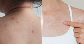 สิวอุดตัน-สิวที่หลังและอก