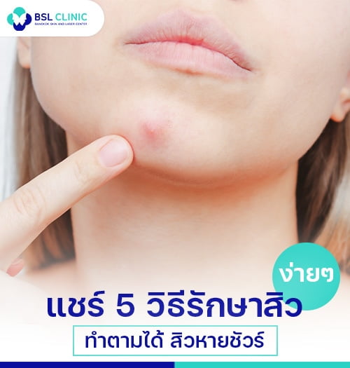รักษาสิว