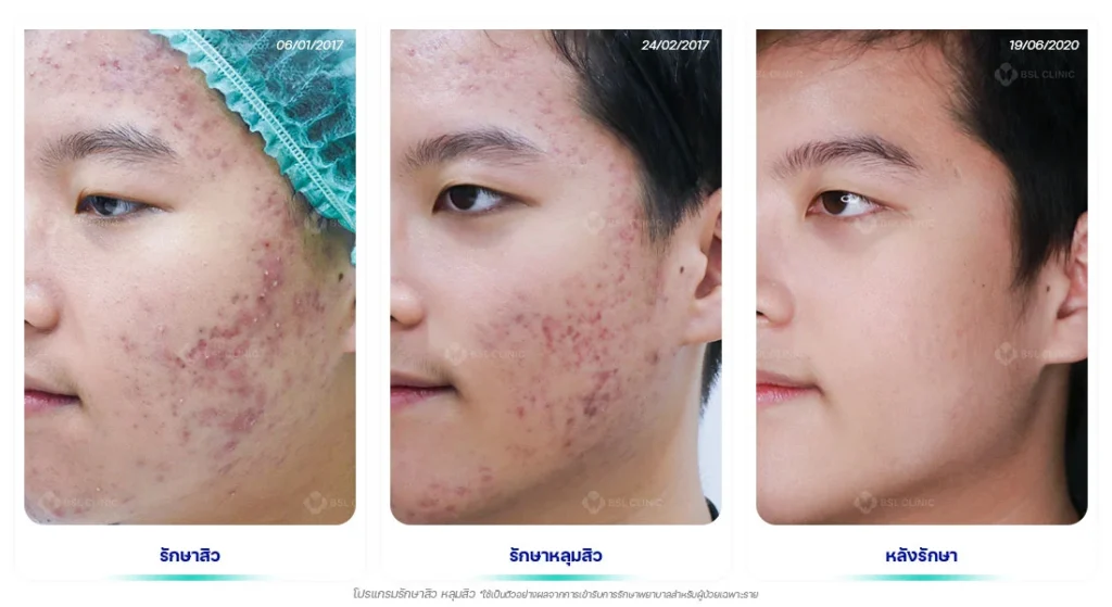 รักษาหลุมสิวกว้าง