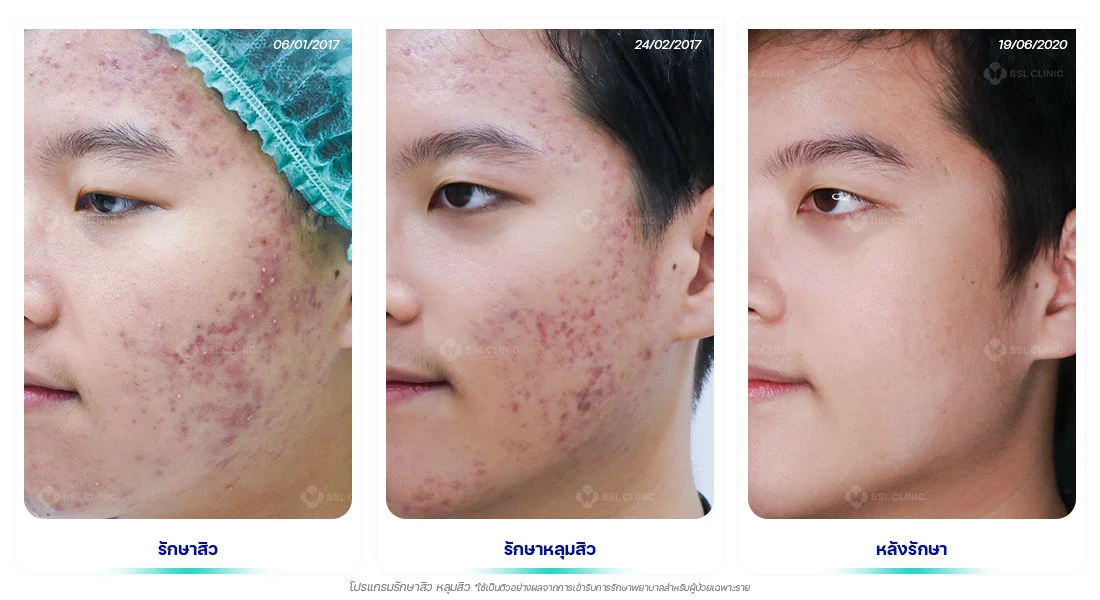 รักษาหลุมสิวกว้าง