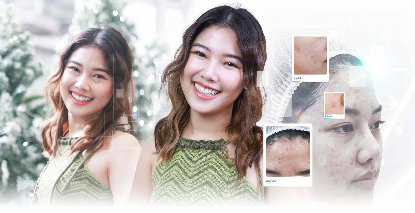 รีวิวรักษาสิว รีวิวสิว ผลการรักษาสิว-result-acne