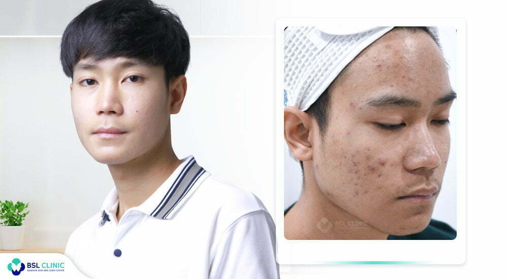 รีวิวสิว-รักษาสิว-สิวผู้ชาย