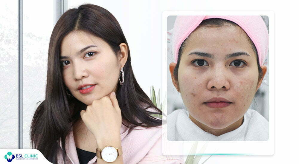 รักษาสิวที่คลินิกไหนดี รีวิวสิว-รักษาสิว-สิวอุดตัน-รอยสิว