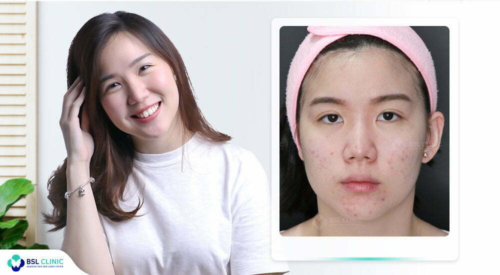รักษาสิวที่คลินิกไหนดี รีวิวสิว-รักษาสิว-เป็นสิว-จนท้อ