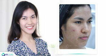 รักษาสิวที่คลินิกไหนดี รีวิวสิว-รักษาสิว-แค่สิวหาย