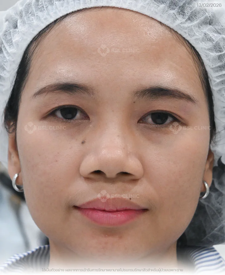 ผลการรักษาสิว-สิวอุดตัน-รอยดำสิว-After