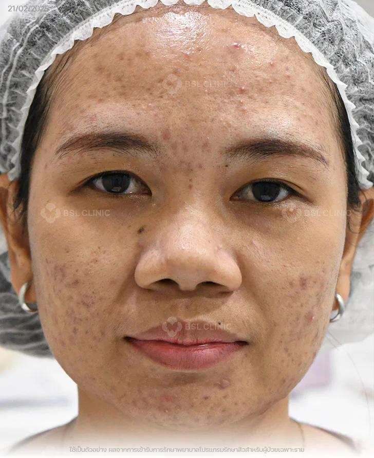 ผลการรักษาสิว-สิวอุดตัน-รอยดำสิว-Before