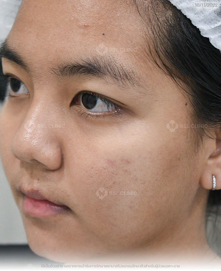 ผลการรักษาสิว-สิวอุดตัน-สิวอักเสบ-รอยแดงสิว-After